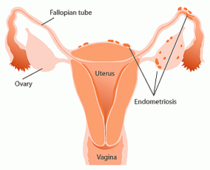 Endometriosis Location